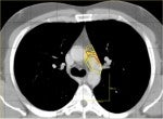 Screening Significantly Increases Long-Term Survival Rates in Lung Cancer