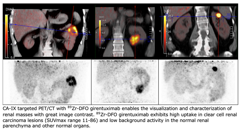 Radiotracer Identifies, Characterizes Renal Cell Carcinomas
