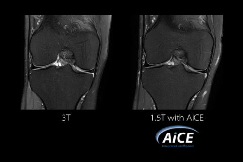 AI-based Image Reconstruction Expands to Body Applications on Galan 3T MR System