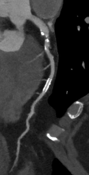 University of Louisville Health Implements Cardiac CT Technology and Expands Patient Eligibility
