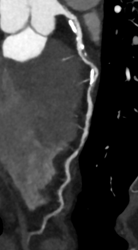 University of Louisville Health Implements Cardiac CT Technology and Expands Patient Eligibility