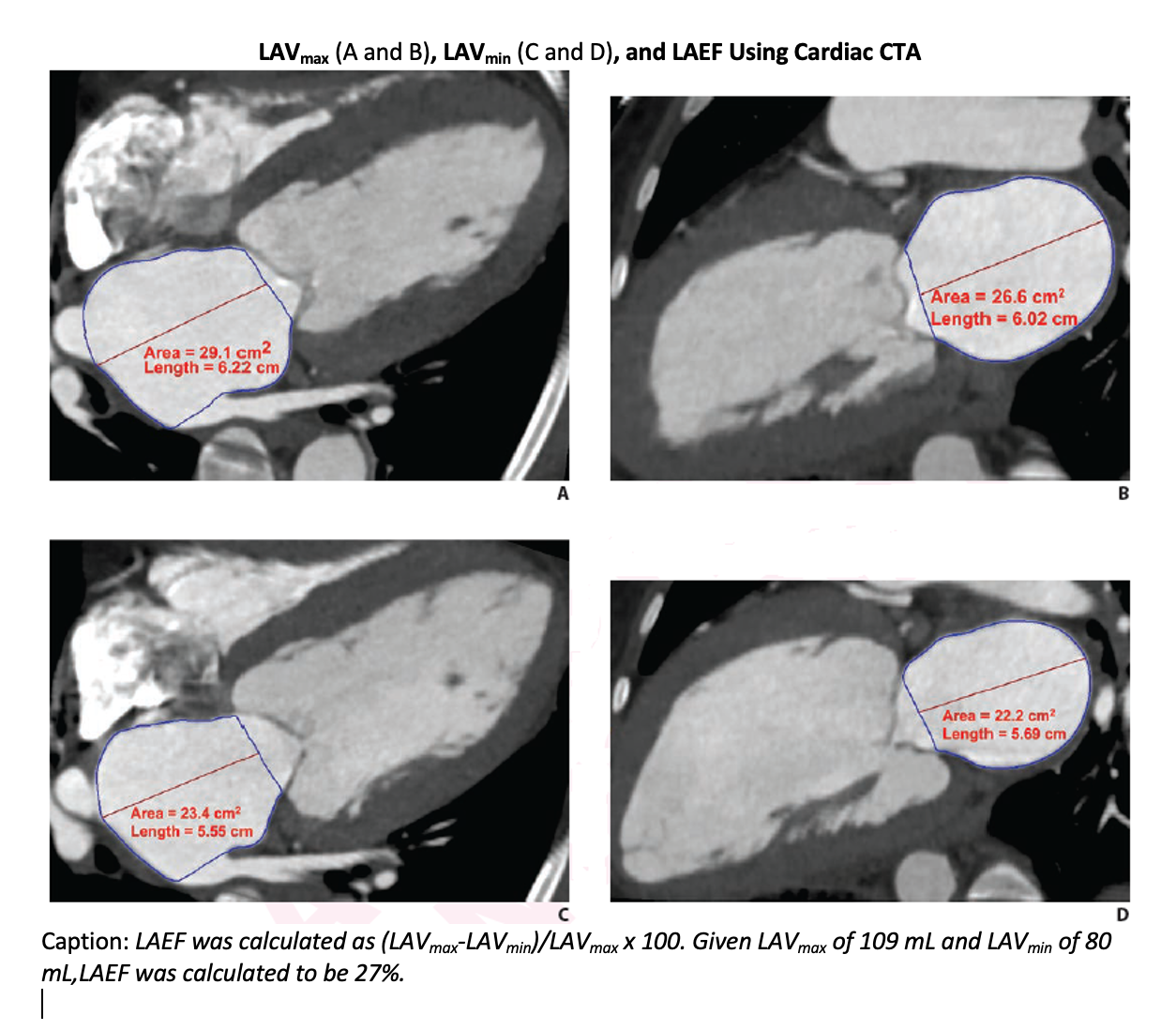 Cardiac CTA Parameters Predict Post-Transcatheter Aortic Valve Replacement Mortality