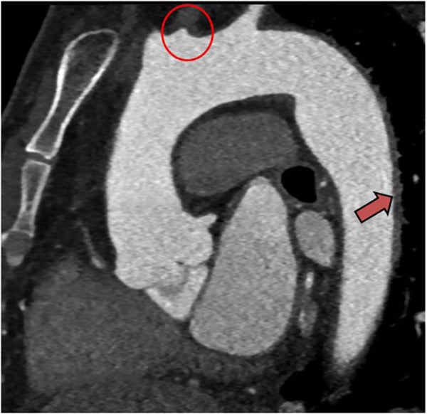 Cardiac CT helpful in patients suspected of cardioembolic stroke
