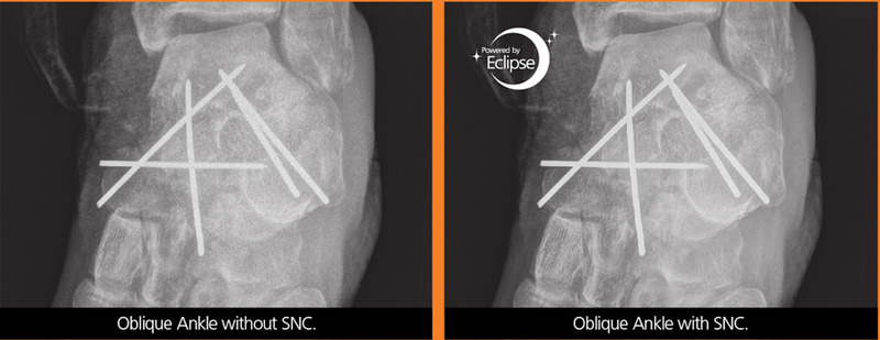 Dose Reduction Technology from Carestream Nets FDA Clearance