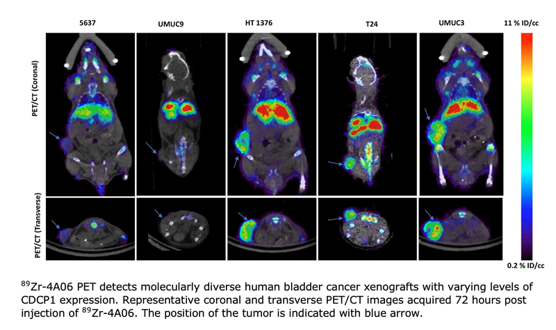 Radiopharmaceutical Therapy Target Discovered for Metastatic Bladder Cancer