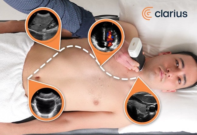 Clarius Ultrasound Systems Use AI to Recognize Anatomy