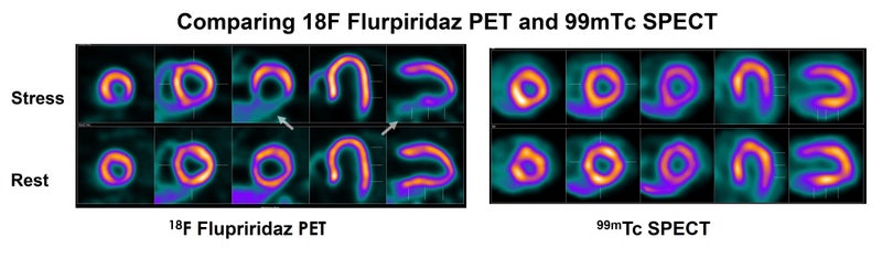 [18F]Flurpiridaz PET May Improve Coronary Artery Disease Detection