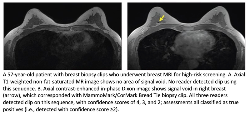 Contrast-Enhanced In-Phase Dixon Sequence for Detecting Breast Biopsy Clips