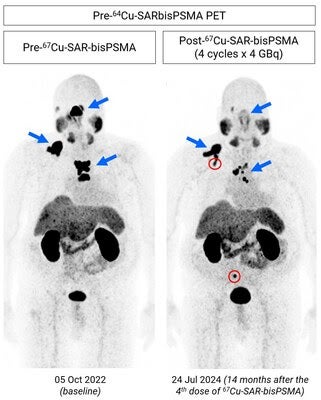 Positive Findings Reported for SECuRE Copper-67 Clinical Trial