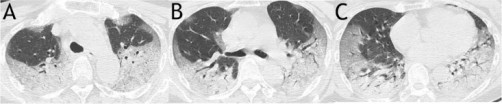 Studies Examine CT Scans to Correlate Clinical Features with Mortality, Use SIRD Model to Predict COVID-19 Spread
