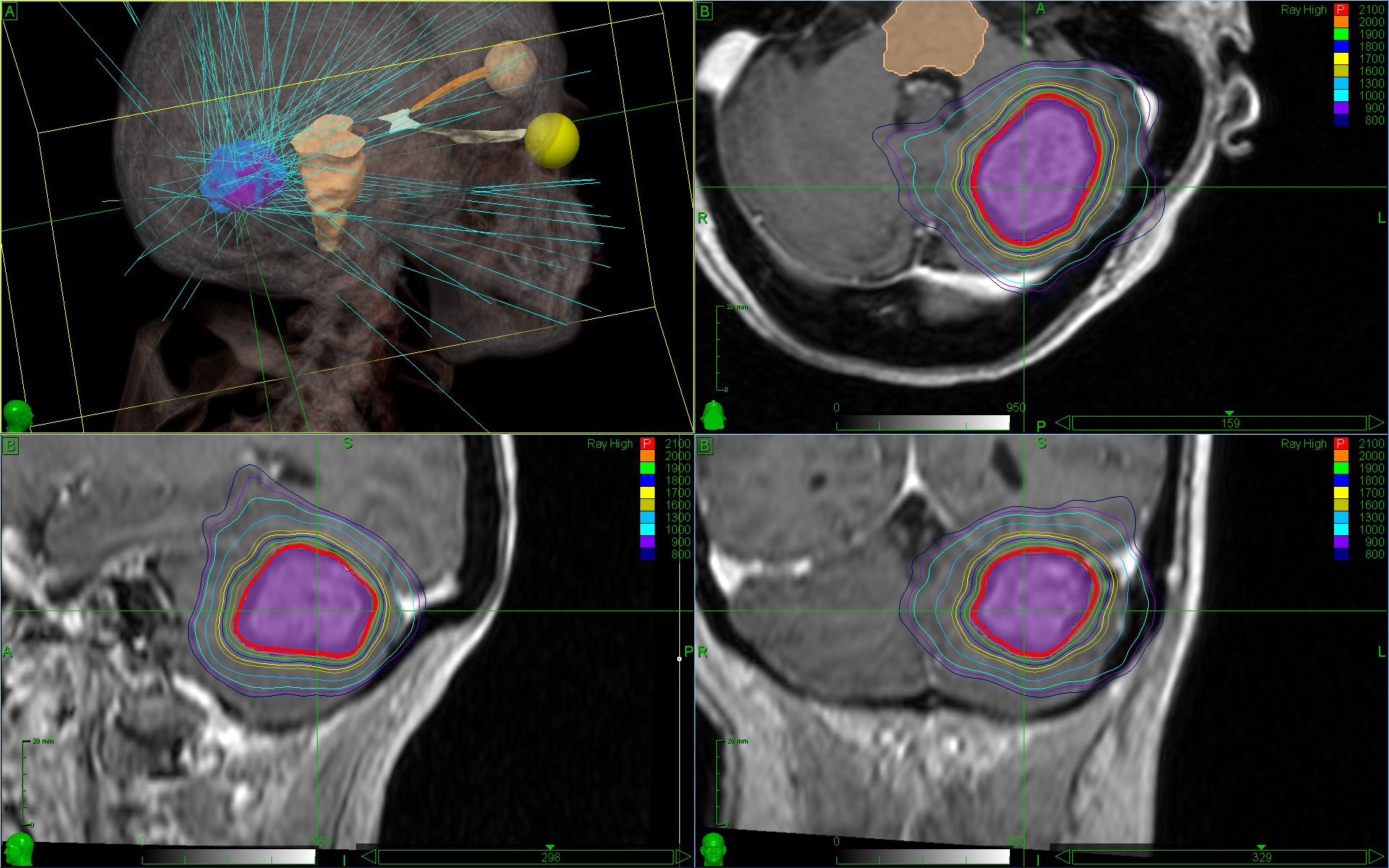 Study Shows Benefit of SRS Treatments for Brain and Spine Lesions