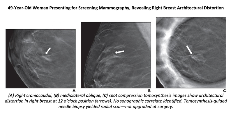 Imaging Surveillance for Nonmalignant Architectural Distortion on DBT