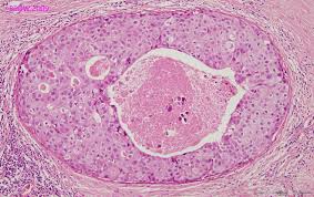 PREDICT Study Demonstrates 40 Percent Change in Radiation Therapy Treatment for DCIS Patients