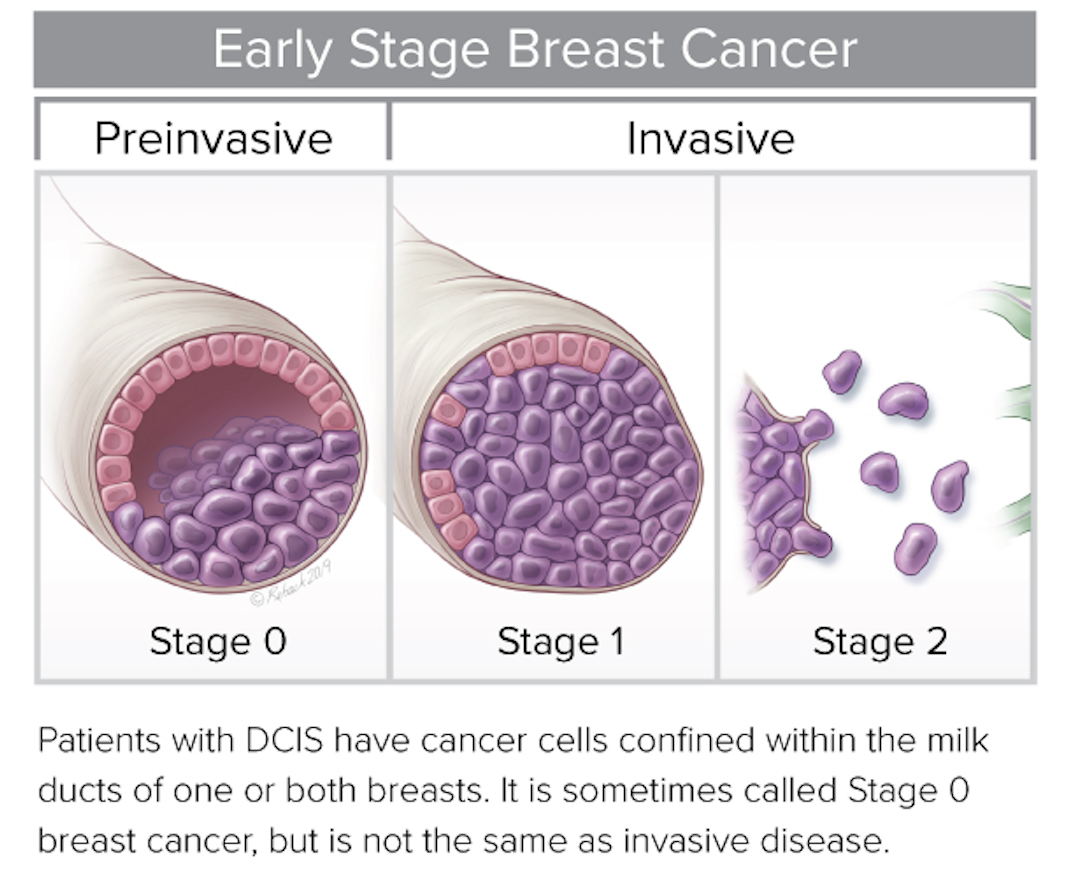 PreludeDx Presents DCIS Precision Medicine Study Results