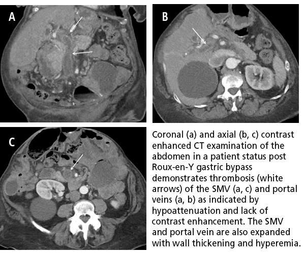 Identifying superior mesenteric venous thrombosis in bariatric surgery patients