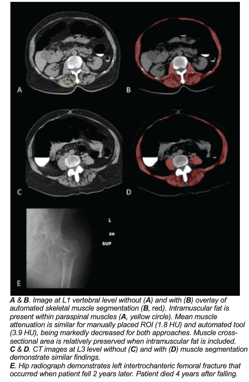 Study: Use of L1 Vertebral Level Expands Reach of CT Screening for Sarcopenia