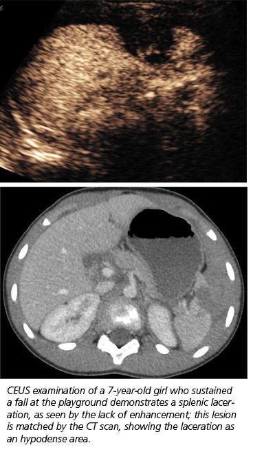 CEUS can reduce need for CT exams for children with abdominal trauma