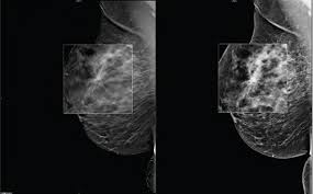 Study Links Breast Calcification Status to Molecular Characteristics