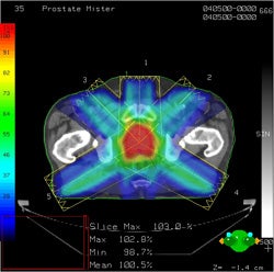 Link Found Between Early Side Effects from Prostate Cancer Radiation and Long-Term Side Effects