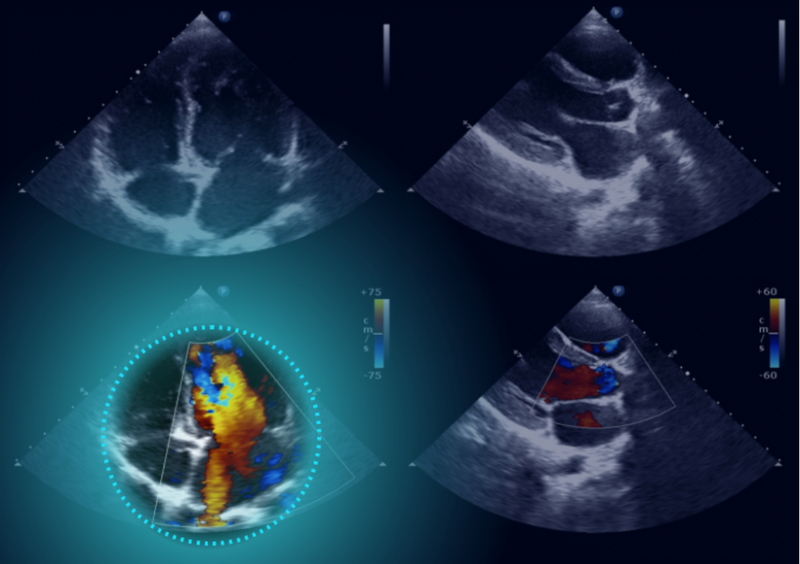 Dyad’s AI-Powered Echocardiogram Analysis Program Gets FDA Clearance