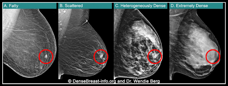 FDA Breast Density Reporting is in Effect. Ready for Patient Conversations?