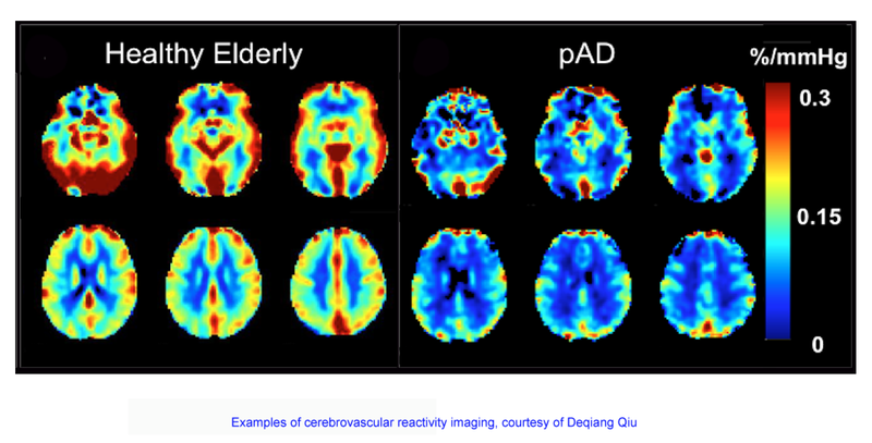 Emory Researchers to Advance Brain Imaging Techniques for Alzheimer’s