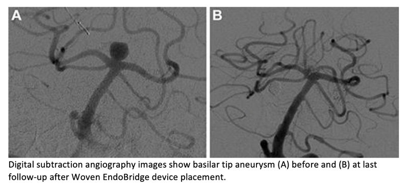 Novel Mesh Plug Also Effective for Sidewall Brain Aneurysm