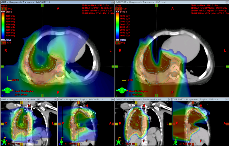 Study Reveals Insights on Sarcoma Rates in Military Versus Civilian Men