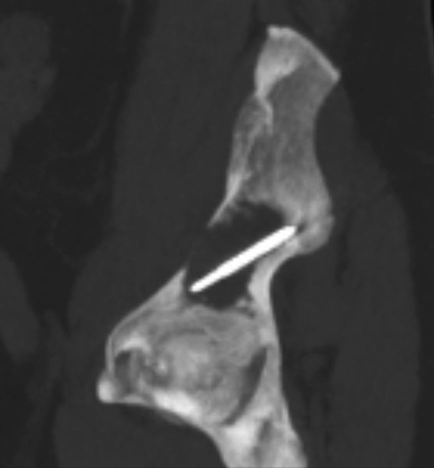 Complex Extraspinal Musculoskeletal Interventions: Role of 4D CT (Angio-CT) in Planning and Treatment