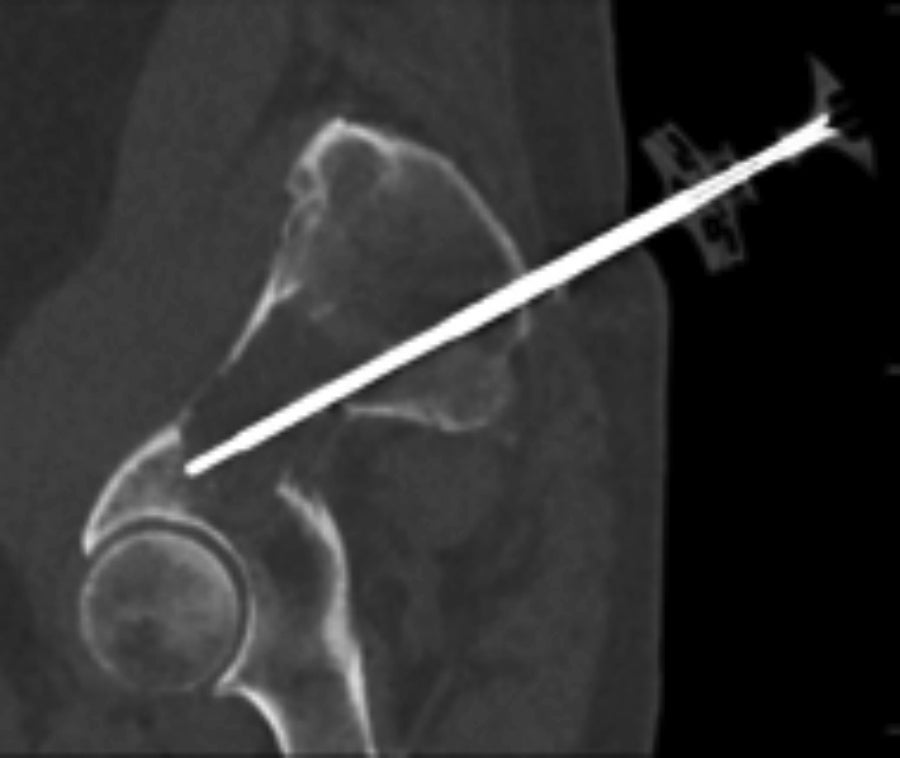 Complex Extraspinal Musculoskeletal Interventions: Role of 4D CT (Angio-CT) in Planning and Treatment