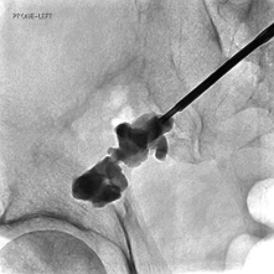 Complex Extraspinal Musculoskeletal Interventions: Role of 4D CT (Angio-CT) in Planning and Treatment