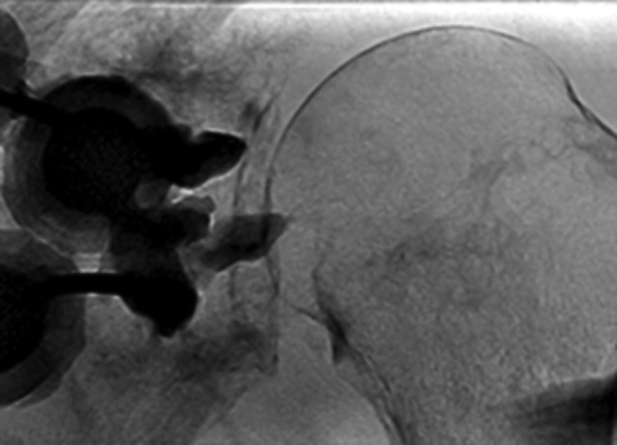 Complex Extraspinal Musculoskeletal Interventions: Role of 4D CT (Angio-CT) in Planning and Treatment