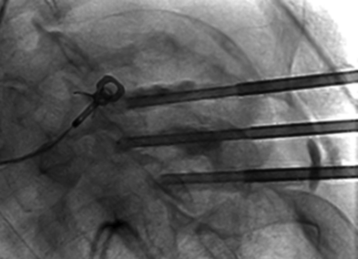 Complex Extraspinal Musculoskeletal Interventions: Role of 4D CT (Angio-CT) in Planning and Treatment