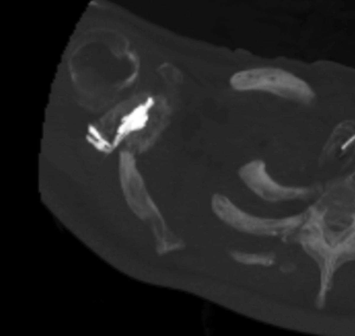 Complex Extraspinal Musculoskeletal Interventions: Role of 4D CT (Angio-CT) in Planning and Treatment