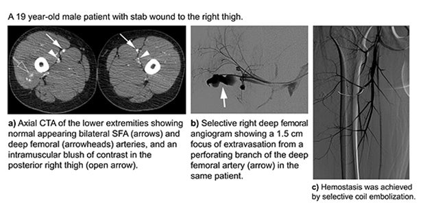 Extremity CTA: Rapid, accurate imaging of vascular trauma