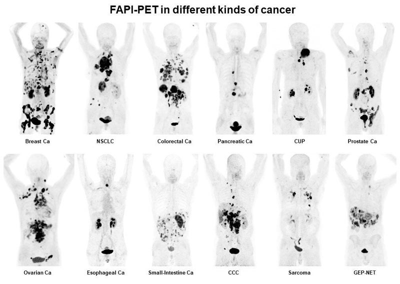 Mayo Clinic to Lead Study of New Radiotracer for Detecting Pancreatic Cancer