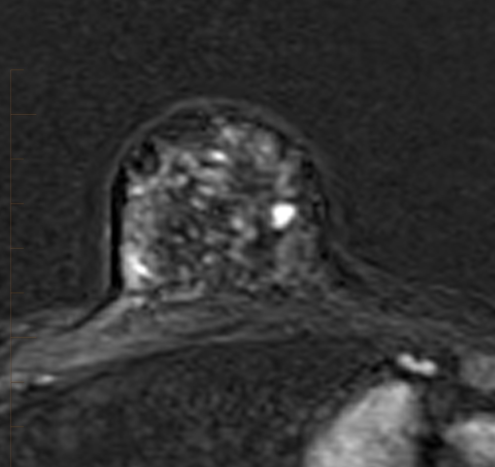 FAST breast MRI can replace conventional breast MRI