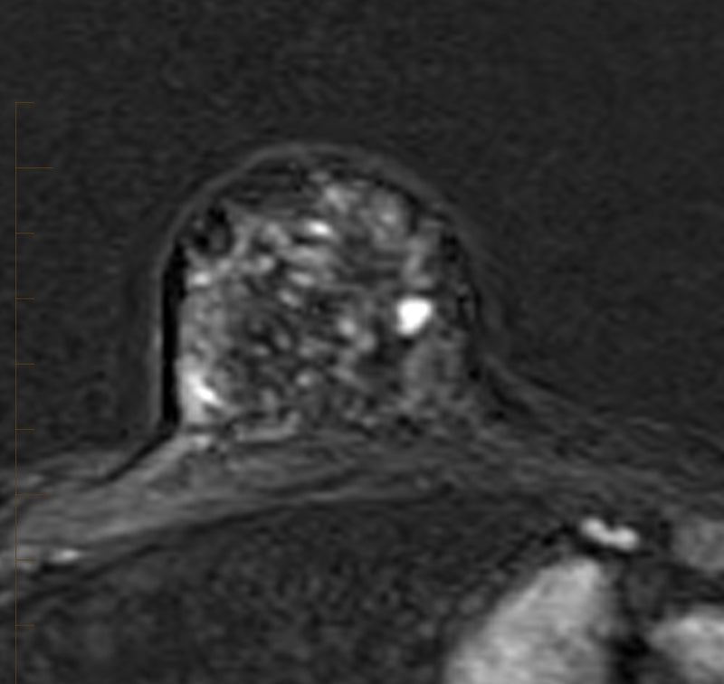 Breast MRI Insufficient to Avoid Surgical Axillary Staging in Patients Receiving Neoadjuvant Endocrine Therapy