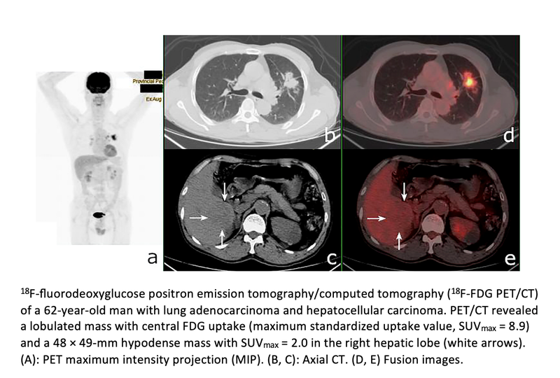 FDG PET/CT Improves Diagnosis of Synchronous Multiple Primary Malignant Neoplasms