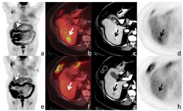 PET/CT preferred for monitoring metastatic breast tumors
