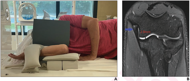 FEVER View Improves Elbow MRI Visualization in MLB Pitchers