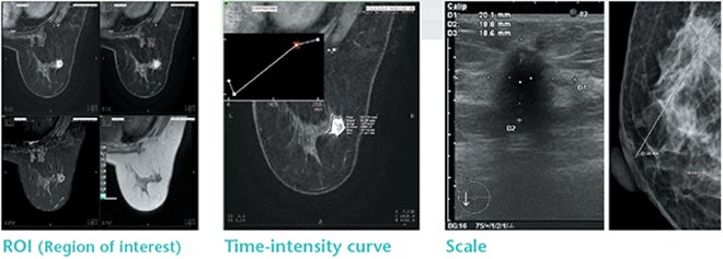 Fujifilm’s ASPIRE Cristalle Mammography System: Inspiring Diagnostic Confidence