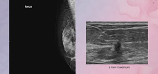 Fujifilm’s ASPIRE Cristalle Mammography System: A Radiologist’s Personal Experience