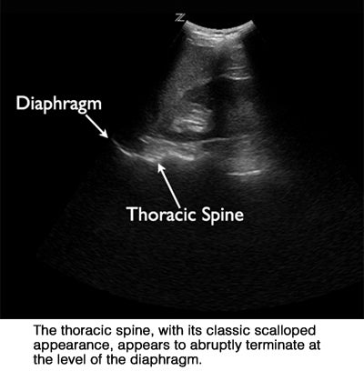 Extension of thoracic spine sign: a sonographic marker of pleural effusion