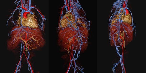 Ferumoxytol-enhanced MR venography feasible for children with chronic kidney disease