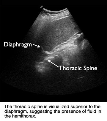 Extension of thoracic spine sign: a sonographic marker of pleural effusion
