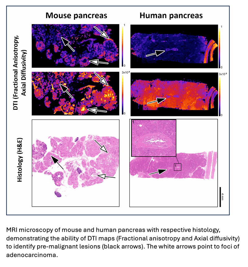 DTI MRI Detects Pre-Malignant Pancreatic Lesions