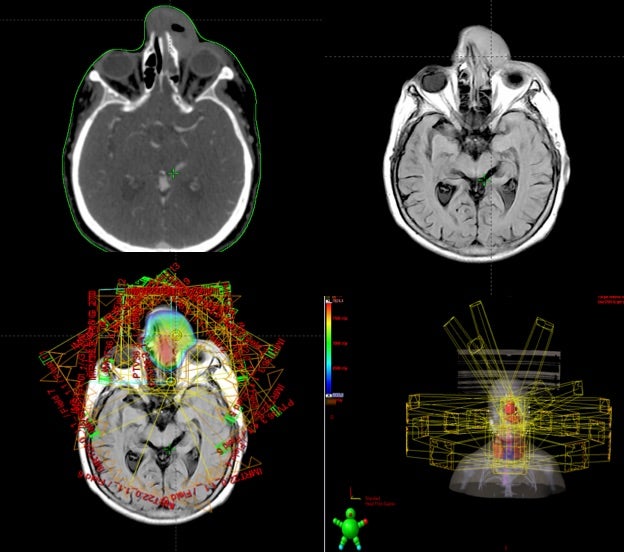 Radiotherapy Treatment in Nasal Diffuse Large B-Cell Lymphoma: A Case Report