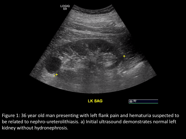 Suspect flank pain? Consider ultrasound for first-line imaging
