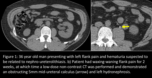 Suspect flank pain? Consider ultrasound for first-line imaging